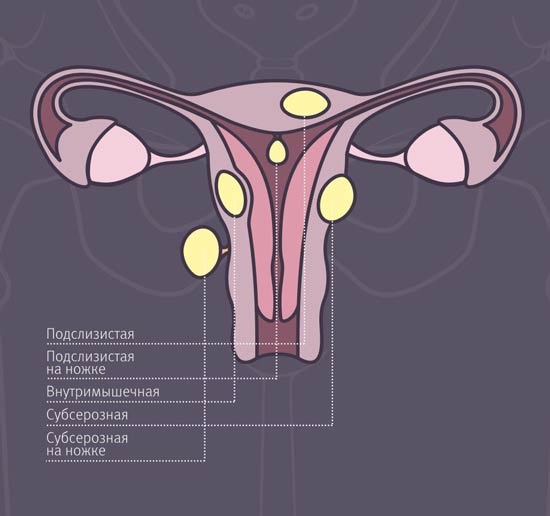 Субмукозный узел в матке фото